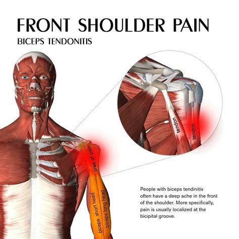 Shoulder Pain- Biceps Tendonitis Treatment