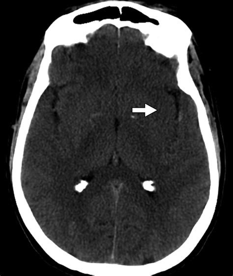 Tamil Meaning Of Cerebral Edema at Norma Plouffe blog