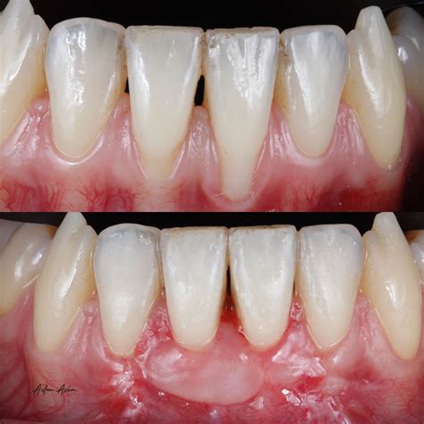 How Gum Grafts Transform Receding Gums and Boost Confidence | The Vallance Dental Centre