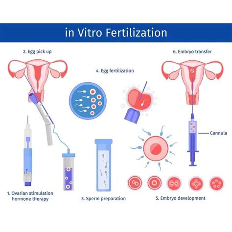 Image result for Vitro Fertilization IVF Process
