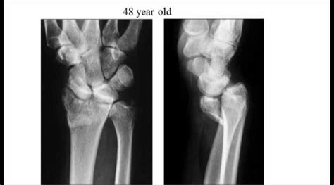 Radius Fracture 的图像结果