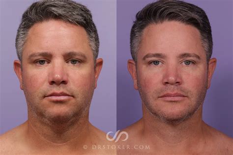 Cheek Fat Reduction