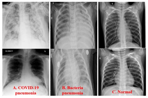 Fusion-Extracted Features by Deep Networks for Improved COVID-19 Classification with Chest X-ray ...