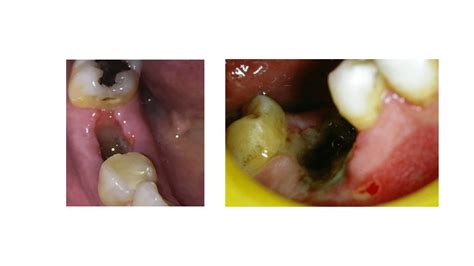 Tooth Socket After Extraction 的图像结果
