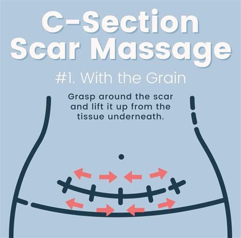 How To Heal C-Section Scar Pain & Sensitivity — Boston Pelvic Physical Therapy