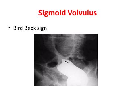 Volvulus of colon | PPTX