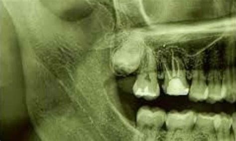 Third molars with completely formed roots suitable donors for replacing ...
