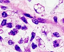 liposarcoma 的图像结果