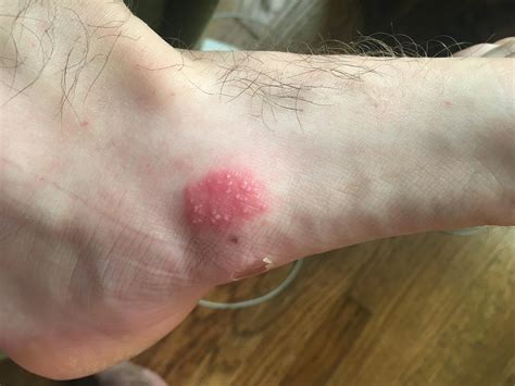 Itchy rash on foot with small blisters forming : Dermatology
