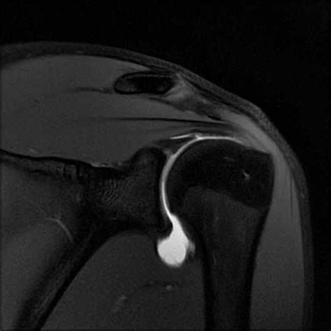 Mr Arthrogram Shoulder 的图像结果