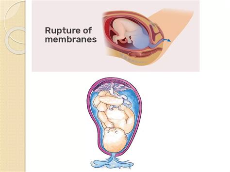 Pre-Labor Rupture of Membranes (PROM) | PPTX