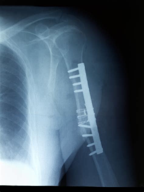 Arm exercises after broken middle humerus surgery - little growing bones