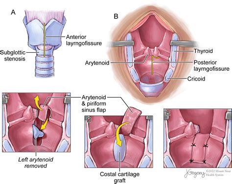 Tracheal Resection For Subglottic Stenosis