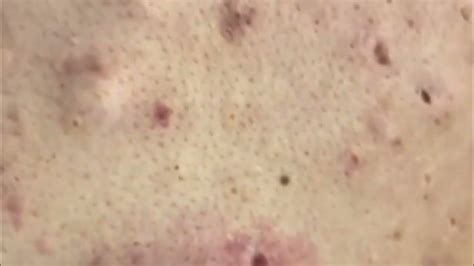 Image result for Exploding Zits On Animals