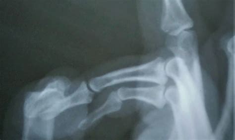 Image result for Finger Dislocation Treatment