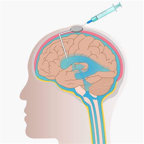 Treatment For Brain Cancer