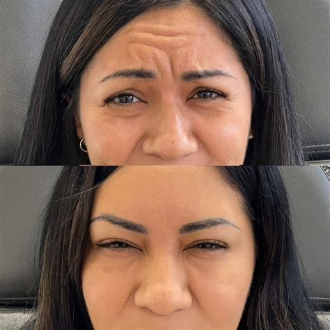 Botox in Riverside, CA - Skin Clinic Med Spa