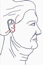 Facelift - AMICUS CLINIC