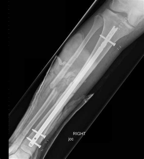 Tibia fracture: Questions about the injury, treatment and recovery | Dr ...