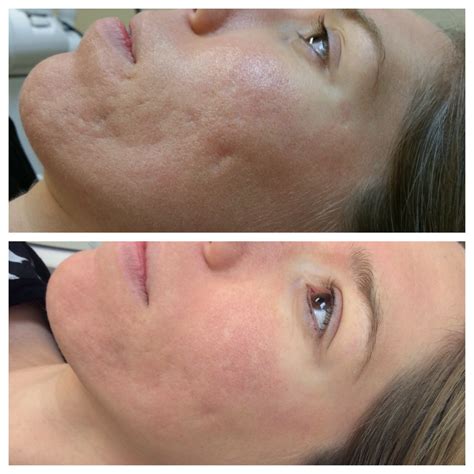 Fractional Laser Scar Treatment Services | Skin Resurfacing