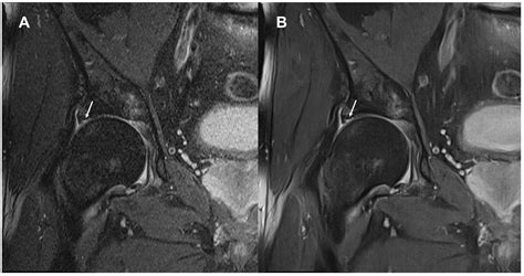 Image Quality and Diagnostic Performance of Accelerated 2D Hip MRI with ...