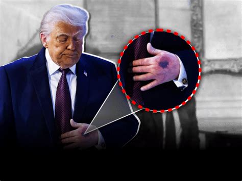 Trumps Davos Hand Bruise & GreenlandIceland Mix-up Spark Health Fears