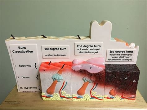 Seeking New Possibilities in Burn Treatment | Article | The United ...
