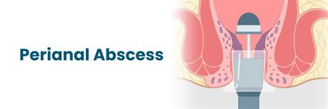 Perianal Abscess: Symptoms, Causes, Diagnosis, and Treatment