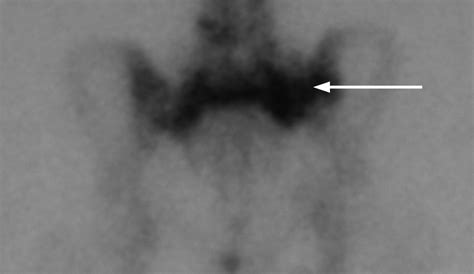 Percutaneous screw fixation for sacral insufficiency fractures | Bone & Joint