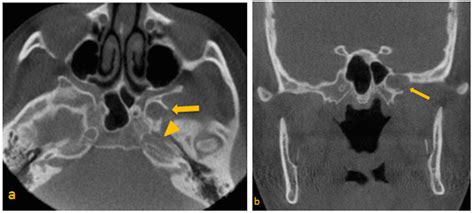 Greater Wing Of Sphenoid Radiograph