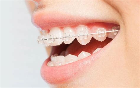Image result for braces
