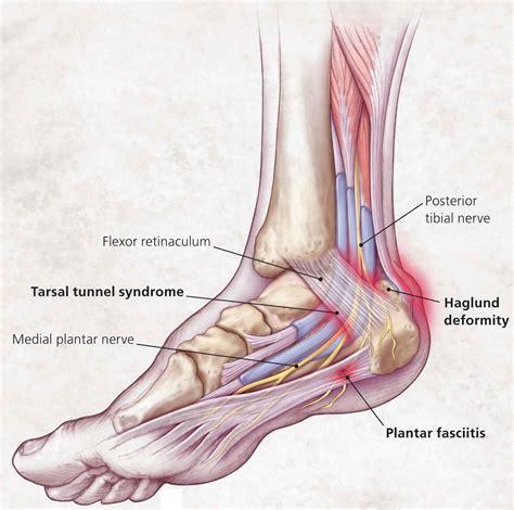 Heel pain causes, symptoms, diagnosis, pain relief & heel pain treatment