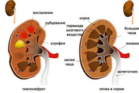 Болит почка с левой стороны: симптомы и лечение