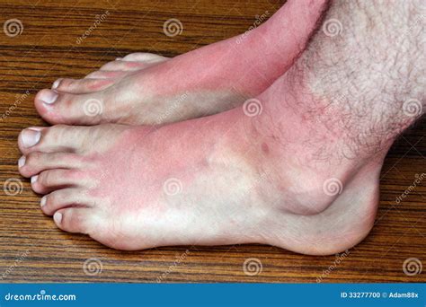 Sunburn on the feet stock photo. Image of sick, heat - 33277700