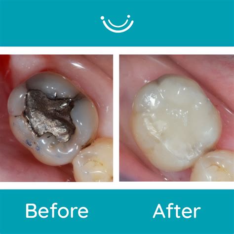 Benefits of White Fillings and Why You Should Choose it Over Amalgam - Kennett Road Dental ...
