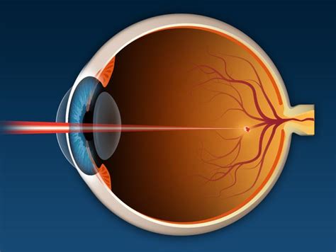 What Is Retinal Laser Photocoagulation?