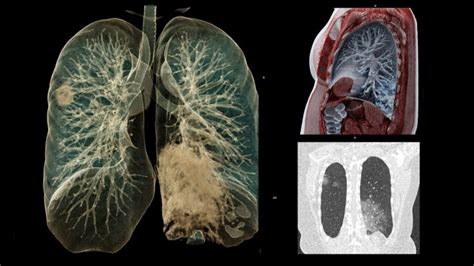 Study Suggests Damaged Lungs Can Repair Themselves Post Covid-19 ...