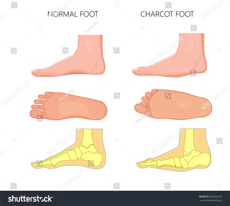 35 Charcot foot: immagini, foto stock e grafica vettoriale | Shutterstock