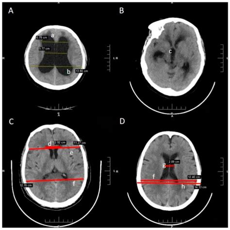 Multiple Machine Learning Approaches for Morphometric Parameters in ...