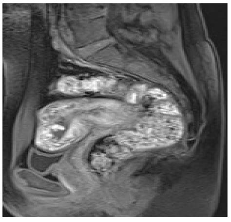 Imaging of Acute Abdominopelvic Pain in Pregnancy and Puerperium—Part I ...