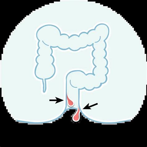 Best Piles, Fistula & Fissure Treatment | Laser & Minimally Invasive Care
