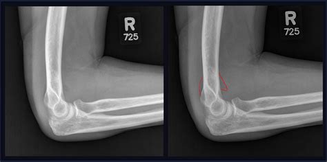 What Is A Elbow Effusion at Tracy Mcfall blog