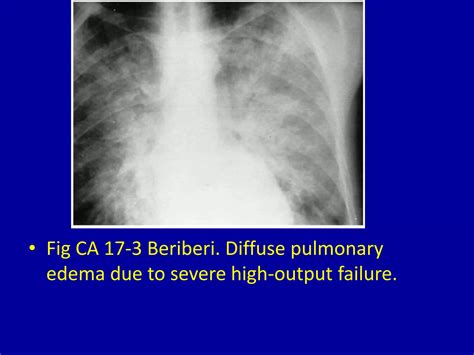 17 high output heart disease | PPTX