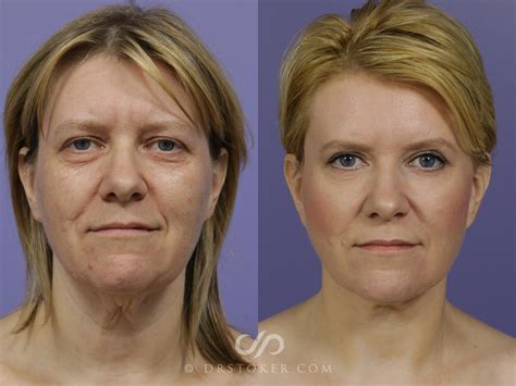 Best Traceless Facelift in Los Angeles – Dr. David Stoker