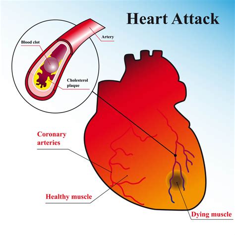 Chest Pain and Heart Attack - Here Is What You Do - Dr Vivek Baliga ...