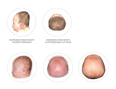 Head Shape Deformities - EARLYstart