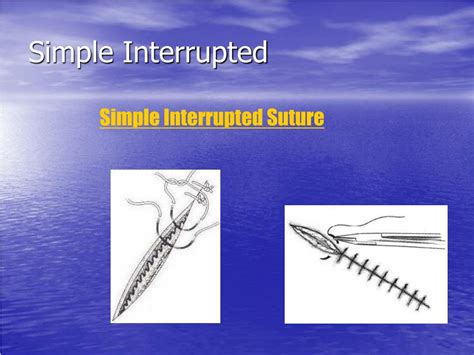 Image result for Simple Interrupted Suture Technique