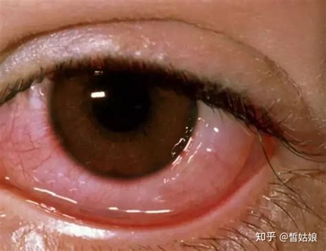 角膜炎VS结膜炎，都是眼睛红肿一字不同天差地别 - 知乎