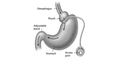 Laparoscopic gastric band (post procedure) - South Tees Hospitals NHS Foundation Trust