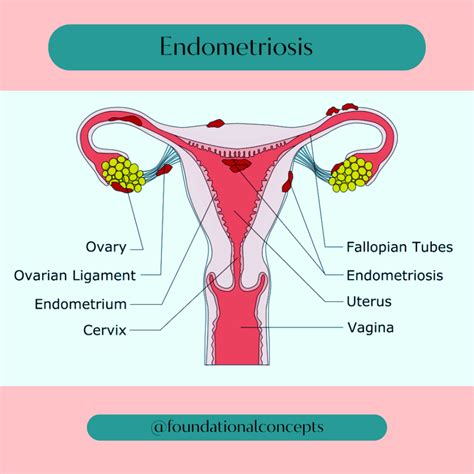 Endometriosis & pelvic floor physical therapy - Foundational Concepts